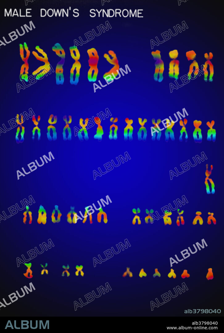 Colour enhanced micrograph of a karyotype for a human male with Down's Syndrome. It is characterized by an extra copy of genetic material on the 21st chromosome. Karyotypes are an arrangement of chromosomes based on their appearance under a light microscope.