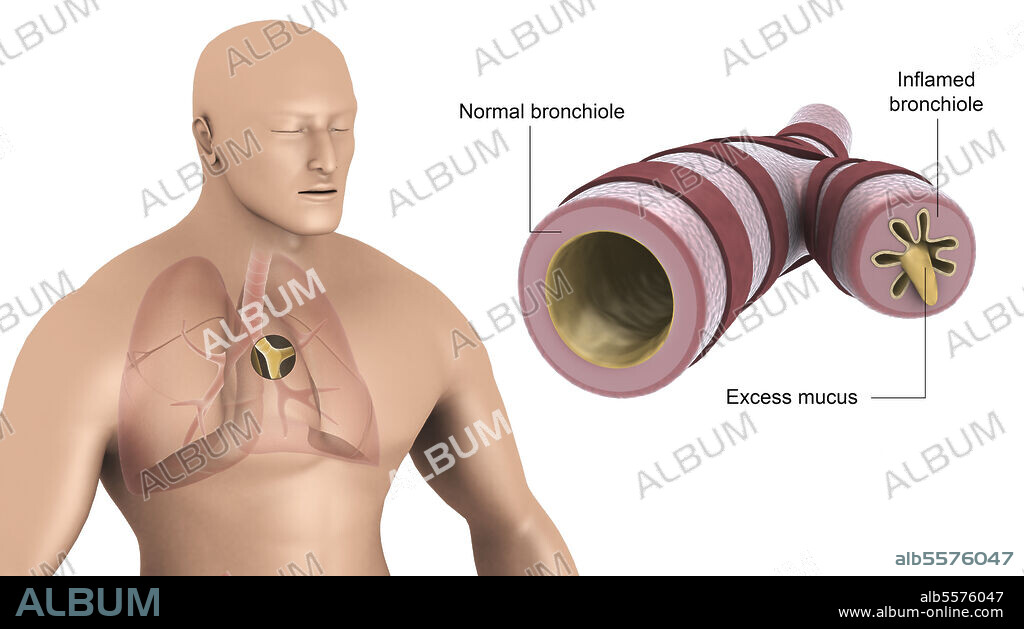 Medical illustration showing bronchitis in human lungs.