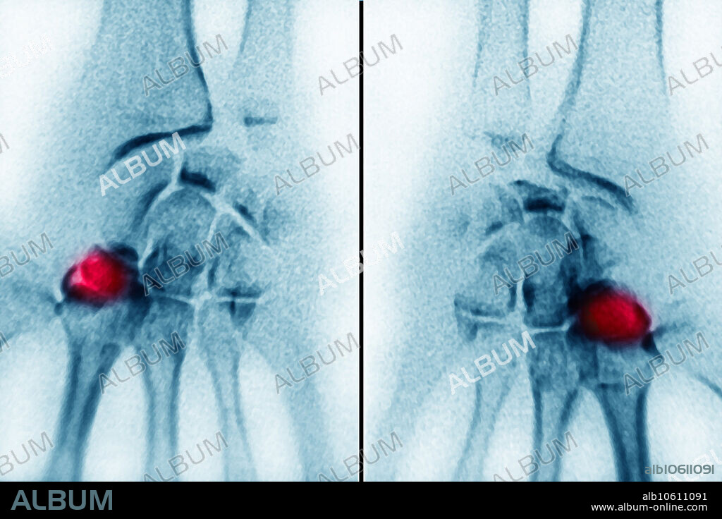 Colour enhanced X-ray of hands showing Kienbock's disease, aseptic necrosis of one bone of the hands bones (here trapezoids bones).