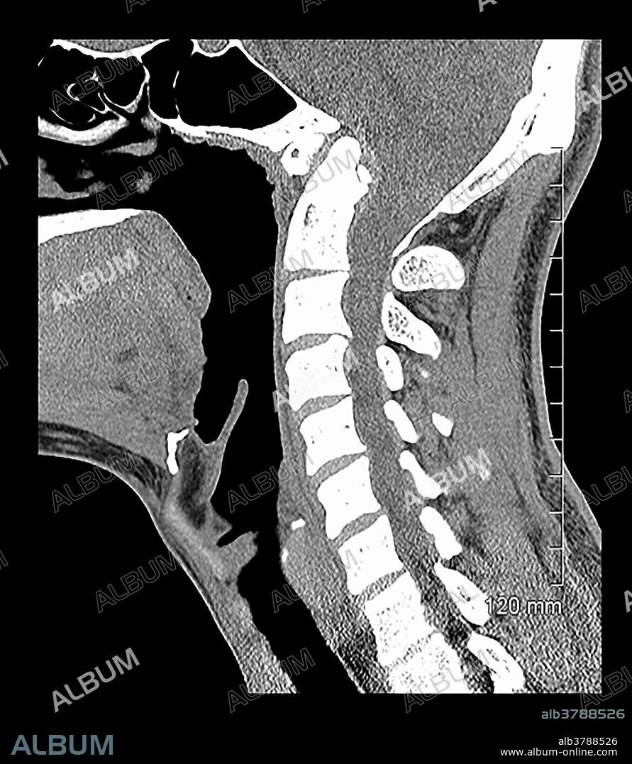 This sagittal (from the side) CT reconstruction of the cervical spine demonstrates congenital fusion of C1 to the skull base with basilar invagination and platybasia. There is also hypoplasia of the basioccipital bone.