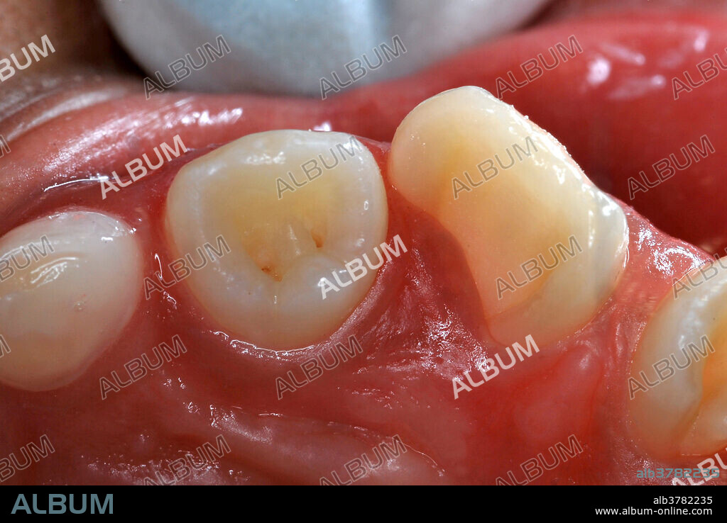 Dens in Dente Malformation of teeth #s 7, 9, and 10 (maxillary right and left lateral incisors, and maxillary left central incisor). Dens in Dente ( tooth within a tooth ), also known as Dens invaginatus, is where the outer surface of the tooth folds inward. Image before restorative procedures.