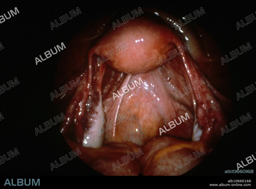 Laparoscopic view of uterus, fallopian tubes, ovaries and uterosacral ligament.