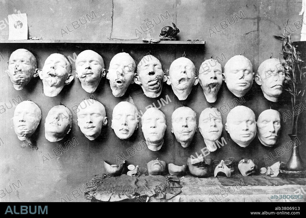 Casts taken from the soldiers' mutilated faces; the lower row shows the faces which Mrs. Ladd modeled on the foundation of the life mask with help of photographs taken before the wound was received. On the table are some of the final masks made to fit over the disfigured part of the face. Anna Coleman Watts Ladd was an American sculptor. In late 1917 she travelled to Paris and founded the American Red Cross "Studio for Portrait-Masks" to provide cosmetic masks to be worn by men who had been badly disfigured in World War I. Soldiers would come to Ladd's studio to have a cast made of their face and their features sculpted onto clay or plasticine. This form was then used to construct the prosthetic piece from extremely thin galvanized copper. The metal was painted to resemble the recipient's skin. Her services earned her the LÃ©gion d'Honneur Crois de Chevalier and the Serbian Order of Saint Sava. In 1936, Ladd retired with her husband to California, where she died in 1939 at the age of 60.