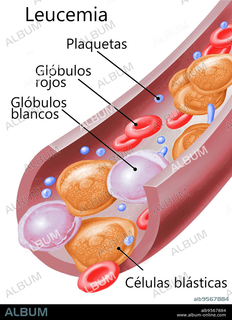 A drawing of blood cells with leukemia, showing platelets (blue), red blood cells (red), white blood cells (light purple) and blast cells (orange). Leukemia is a group of cancers that usually begin in the bone marrow and result in high numbers of abnormal white blood cells. The exact cause of leukemia is unknown. Different kinds of leukemia are believed to have different causes. Both inherited and environmental (non-inherited) factors are believed to be involved. Risk factors include smoking, ionizing radiation, some chemicals (such as benzene), prior chemotherapy, and Down syndrome. People with a family history of leukemia are also at higher risk.