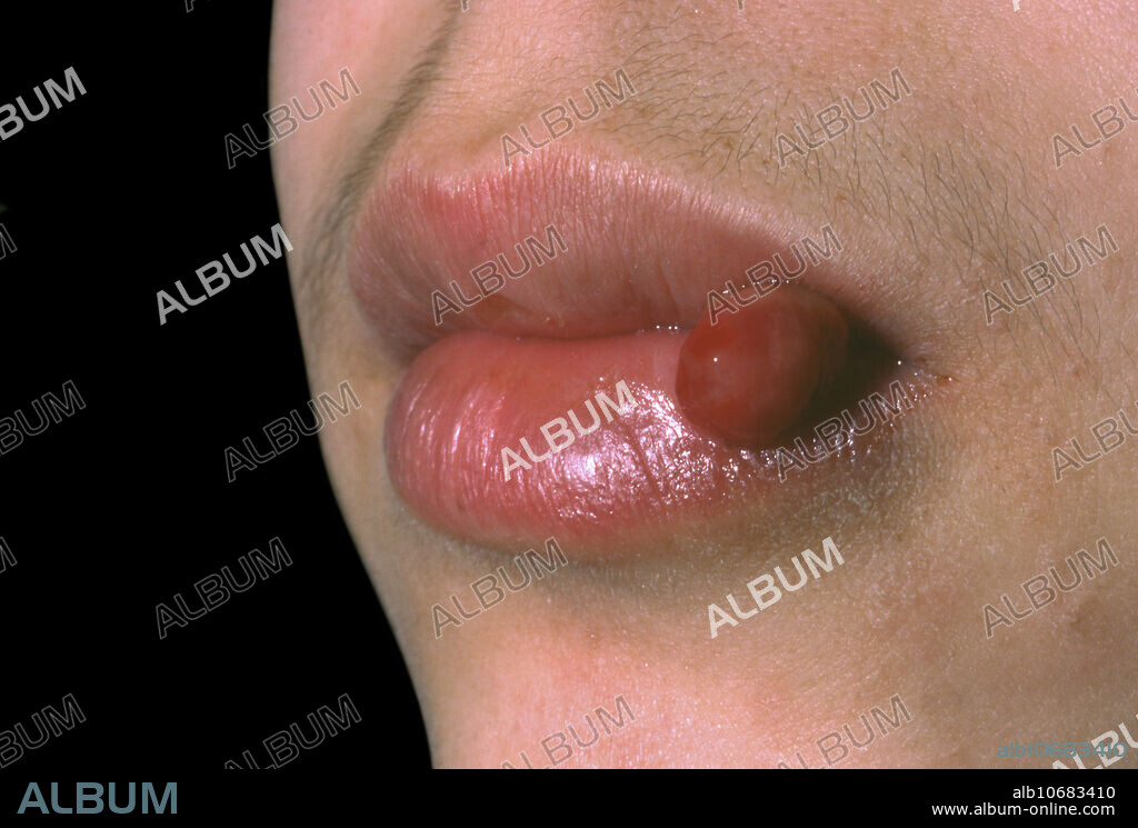 Botryomycome (granulome pyogénique) de la lèvre chez un garçon... Pyogenic granuloma (botryomycoma) on the lip in a boy.