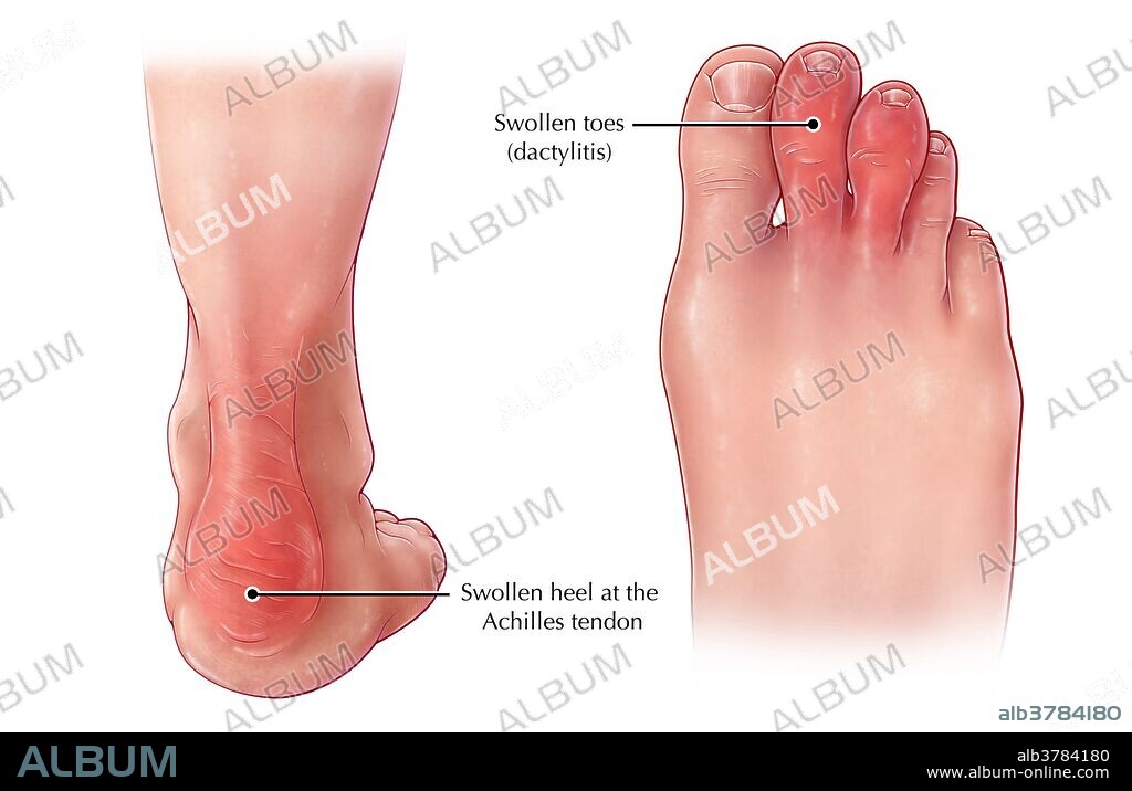 An illustration of symptoms of psoriatic arthritis, a chronic inflammatory skin disease (psoriasis) which is accompanied by arthritis and other joint problems. Swollen heels around the Achilles tendon, as well as dactylitis, swelling of the toes (creating a sausage-like appearance), are characteristic of psoriatic arthritis.