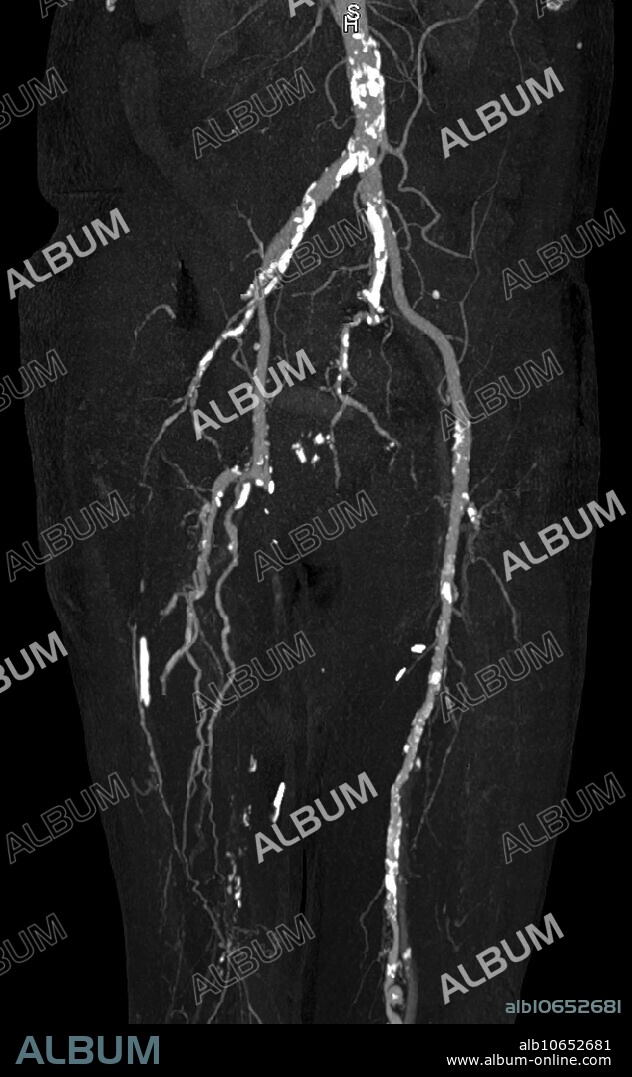 CT angiography of the lower extremities reveals dense calcification (bright white plaques) of abdominal aorta, femoral and popliteal arteries in a 68 year old dialysis patient with chronic renal failure and secondary hyperparathyroidism. The right femoral and popliteal arteries are occluded and collateral vessels are visible in the distal thigh.