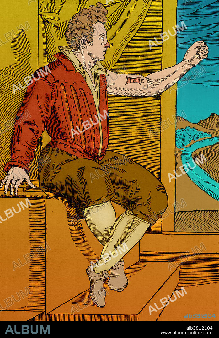 One of Gaspare Tagliacozzi's methods for replacing a missing nose. Here we see the healed patient with a new nose (C, B) and a missing section of skin (E) on his upper arm. This skin has been used to form his new nose. Gaspare Tagliacozzi (1547-1599) was an Italian plastic surgeon. Although reconstructive surgery had been practiced for years, with documented procedures in ancient India, Tagliacozzi popularized the field of plastic surgery, and particularly rhinoplasty, in the 16th century. His book on plastic surgery, in which this illustration appears, is called De Curtorum Chirurgia Per Institionem (1597).