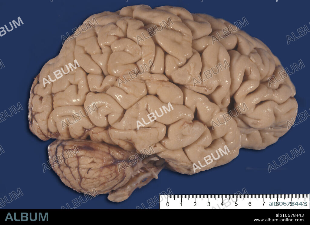 Gross anatomy of the lateral surface of a human brain showing a severe cortical atrophy with enlarged sulci and reduced gyri. This aspect can be seen in Alzheimer disease or senile brain.