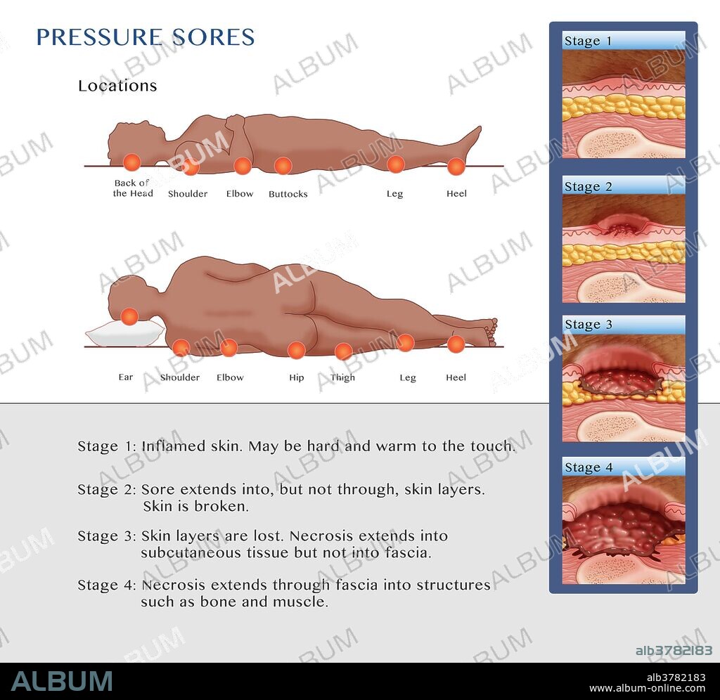 Pressure Sore Locations, Stages 1-4