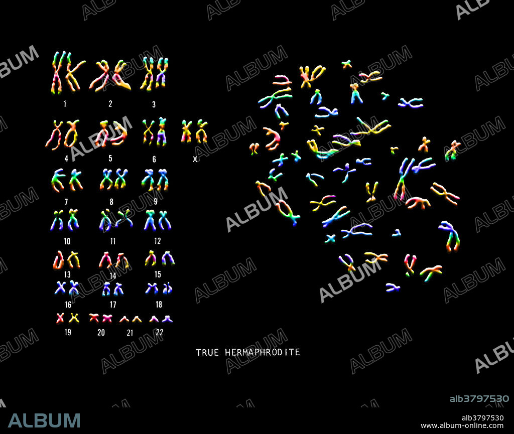 Colour enhanced micrograph of a karyotype of a true hermaphrodite, 46,XX/46,XY.