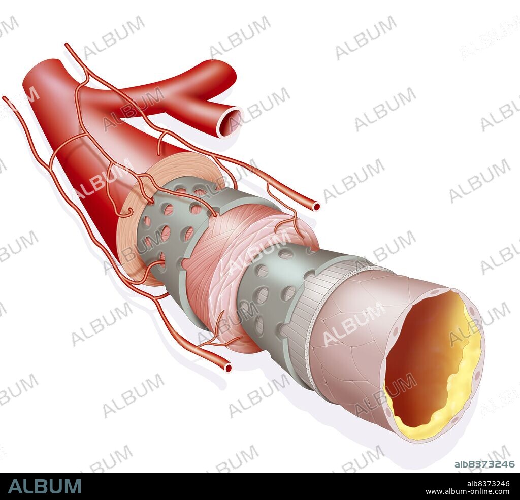 Illustration of an atheromatous plaque, fatty build up (yellow) in a medium caliber artery.. The plaque slows blood flow, which can cause cardio-vascular complications depending on the location of the plaque.. The illustration shows the various layers in the artery.. From outside to inside:. -the tunica externa or adventitia (two types of tissue, connective and muscular). -the tunica media (two types of tissue, external elastic membrane and smooth muscle). -the tunica intima (three types of tissue, internal elastic membrane, connective tissue and endothelium, single layer of cells around the artery’s lumen.). It is in this internal epithelial layer that the artheromatous plaque forms.