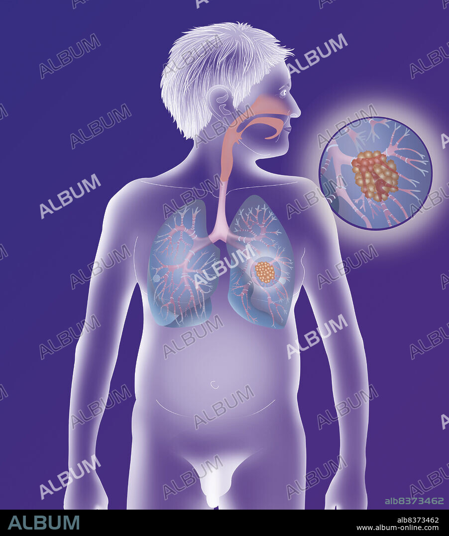 Depiction of a cancerous tumour in the left lung.