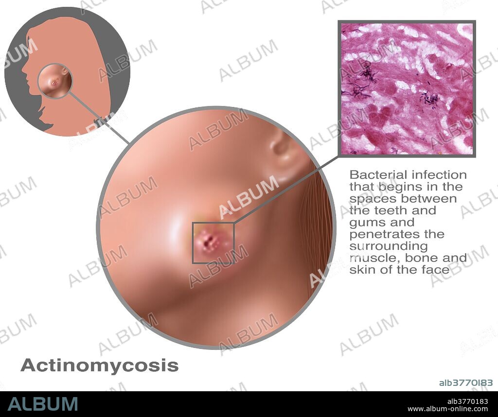 Actinomycosis. Bacterial infection that begins in the spaces between the teeth and gums and penetrates the surrounding muscle bone and skin of the face.