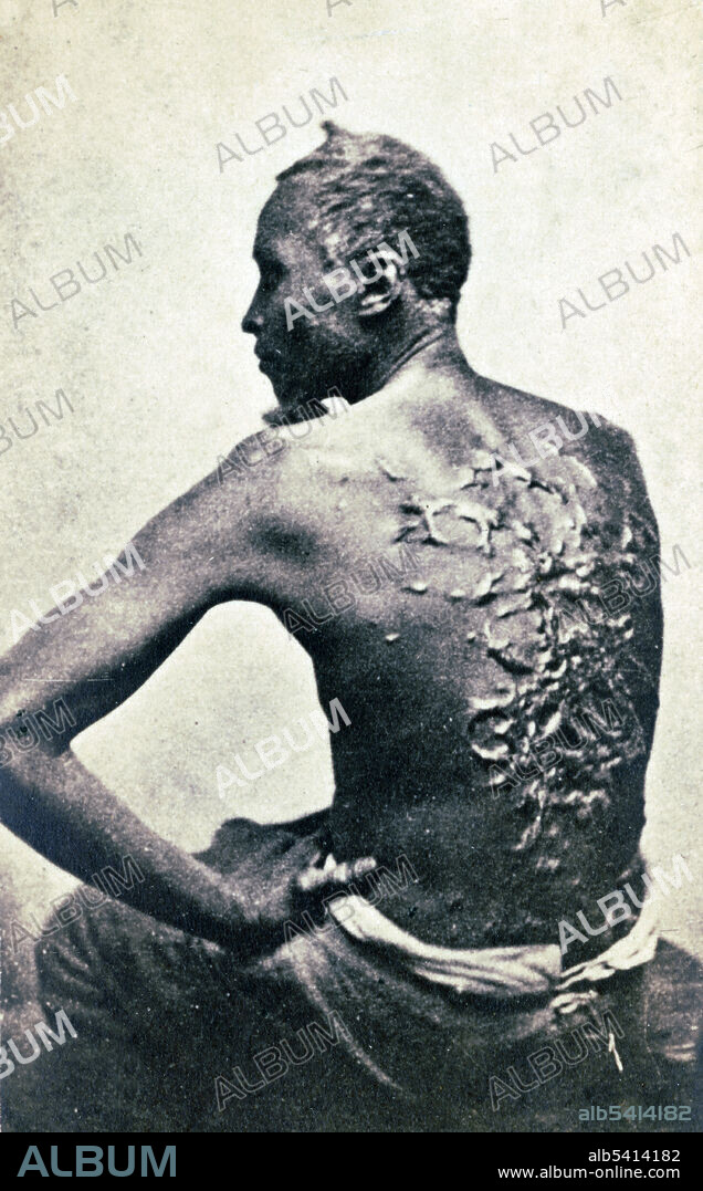 Escaped slave Gordon, also known as Whipped Peter, showing his scarred back at a medical examination, Baton Rouge, Louisiana. Images of Gordon's scourged back appeared in a Harper's Weekly and inspired many free blacks to enlist in the Union Army. McPherson & Oliver, April 2, 1863.