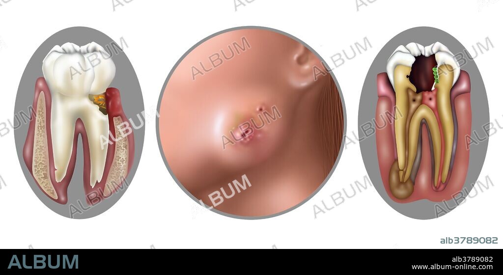Illustration of oral Infections caused by bacteria. Fusobacterium nucleatum, is an oral bacteria found in the dental plaque of humans. Associated with the periodontal gum disease. Actinomycosis. This Bacterial infection begins in the spaces between the teeth and gums and penetrates the surrounding muscle bone and skin of the face. Streptococcus oralis bacteria is found in the cavity of a human tooth. Streptococcus oralis is a type (genus) of spherical bacteria, that can colonize the throat and back of the mouth.