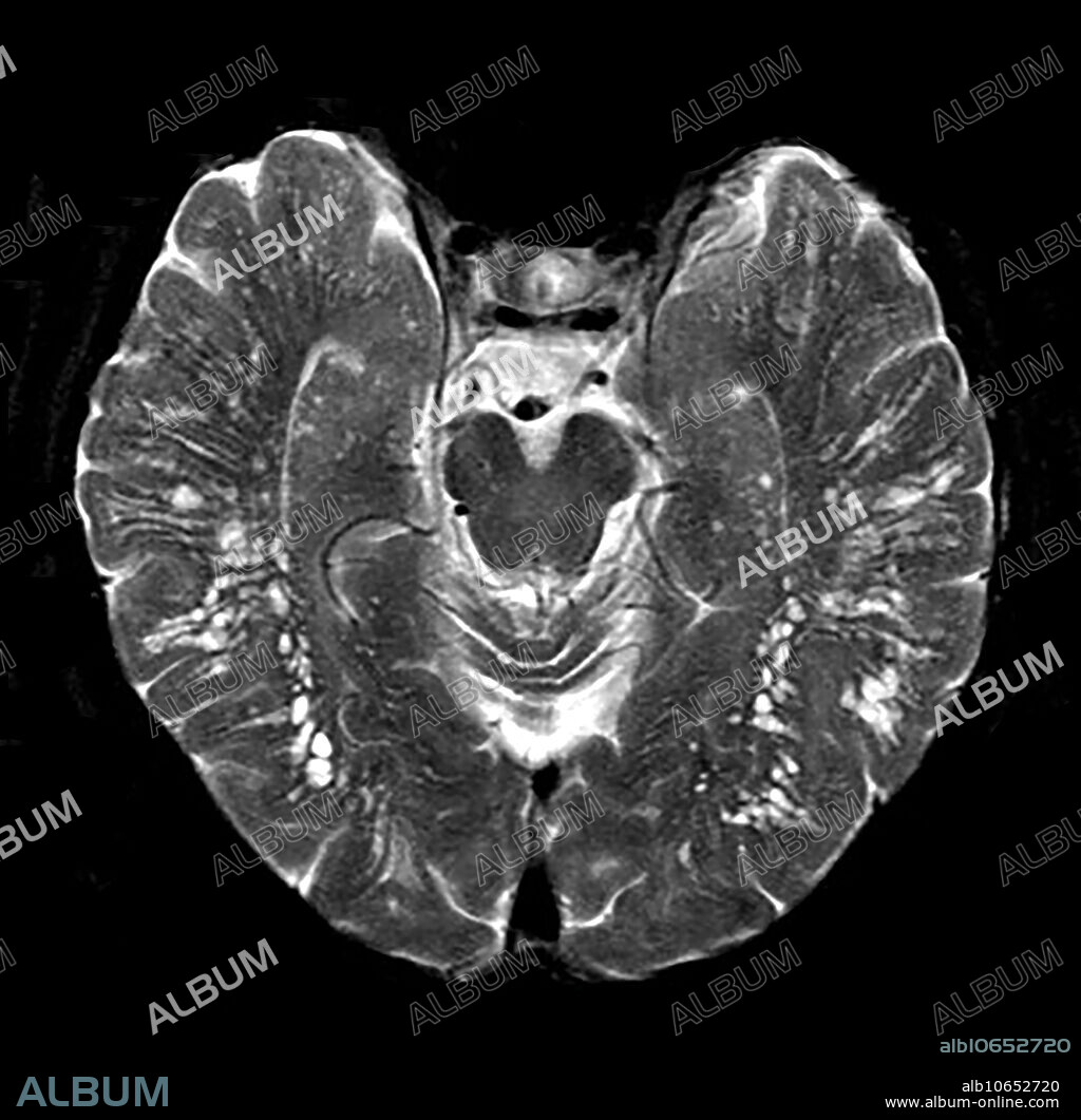 This axial (cross sectional) MRI shows innumerable dilated perivascular spaces (Virchow-Robin spaces). This is a normal variant but can become more prominent with increasing cerebral volume loss.