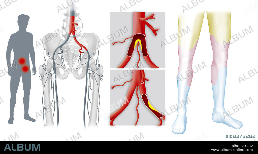 Représentation sur plusieurs schémas de la sténose et occlusion des axes artériels des membres inférieurs. De gauche à droite :. - Situation des zones de sténose au niveau de la bifurcation aortique et de l'artère iliaque sur une silhouette. - Localisation de la sténose ou occlusion au niveau de la bifurcation aortique et de l'artère iliaque sur une vue anatomique. - Zoom de la sténose ou occlusion au niveau de la bifurcation aortique et de l'artère iliaque primitive. - Zones compromises par l'occlusion: occlusion de l'artère fémorale (zone jaune), occlusion de l'artère fémorale et poplitée (zone rose) et occlusion des artères tibiales et péronières (zone bleue).