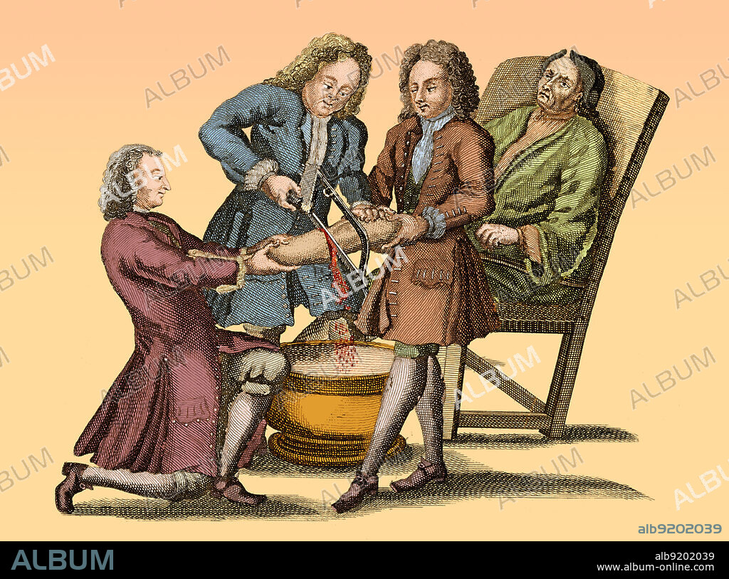 Amputation, Lorenz Heister, 1718. Lorenz Heister (1683-1758) was a German anatomist, surgeon and botanist whose best-known work is Chirurgie, a book on surgery originally published in 1718, from which this 1739 illustration derives. He coined the word "tracheotomy." He is credited with being the first physician to perform a post-mortem section of appendicitis. Colorized.