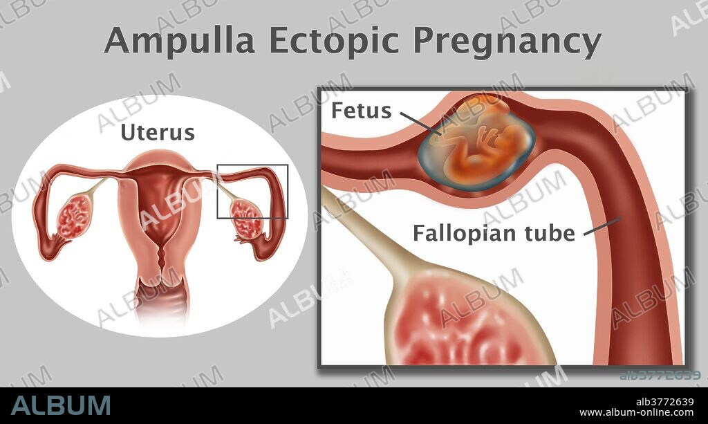 Illustration of an ampulla ectopic pregnancy; a fetus growing in the ampulla (the second portion of the fallopian tube). An ampullar pregnancy is the most common type of tubal ectopic pregnancy. It accounts for about 70% of tube pregnancies.