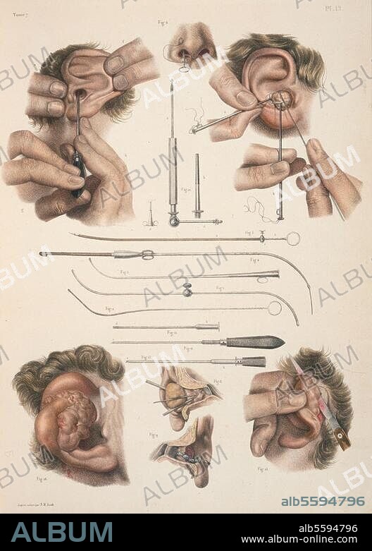 Medicine / Surgery. "Opérations qui se pratiquent sur l'oreille". (Operations on the ear, polyps, tumors etc.). Col. lithograph aft. drawing by Nicolas Henri Jacob (1782-1871). From: M.J. Bourgery, Traité complet de l'anatomie de l'homme, 1831-54, vol. 7, pl. 12. Private Collection.