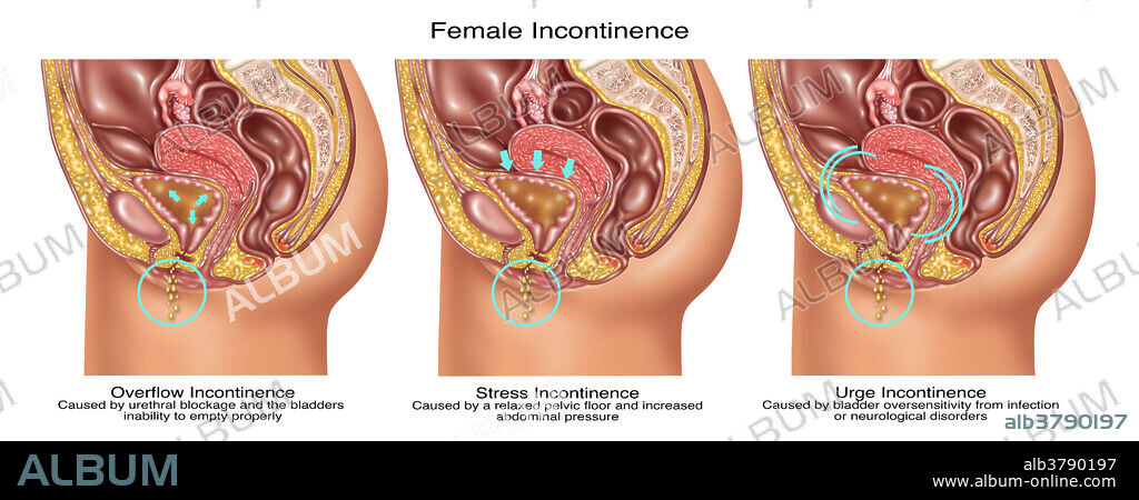 Illustration depicting three types of incontinence: (left to right overflow, stress, and urge. Overflow incontinence occurs in people who have a blockage of the bladder outlet (in this illustration, narrowing of the urethra). Stress incontinence occurs when pressure on the bladder increases due to the pelvic floor relaxing. Urge incontinence is characterized by oversensitivity of the bladder caused by infection or neurological disorders. The latter two types are the most common in women.