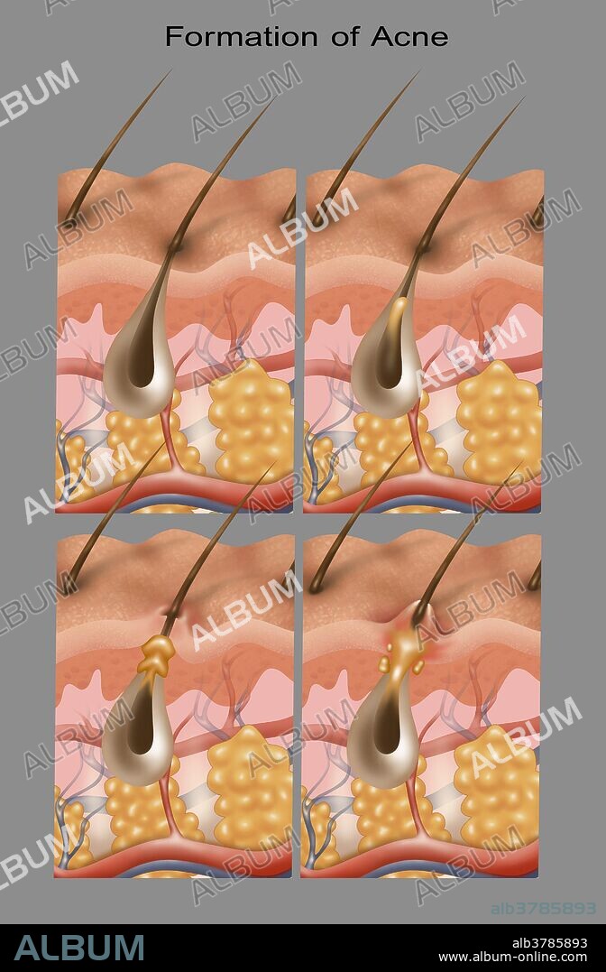 Cross-section illustration of the formation of acne in four steps. From top left to bottom right: normal hair follicle, clogged duct, bacterial infection, and ruptured follicle.