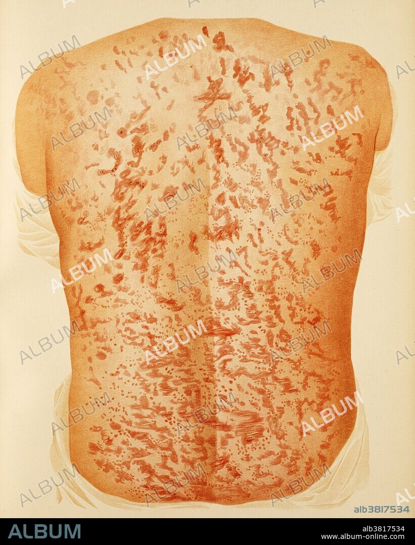 Back of a man with papulosquamous disorder. Also called scaly skin disease. A papulosquamous disorder is a condition which presents with both papules and scales or both scaly papules and plaques. Examples include psoriasis, lichen planus, and pityriasis rosea. H. Radcliffe Crocker, 1896.