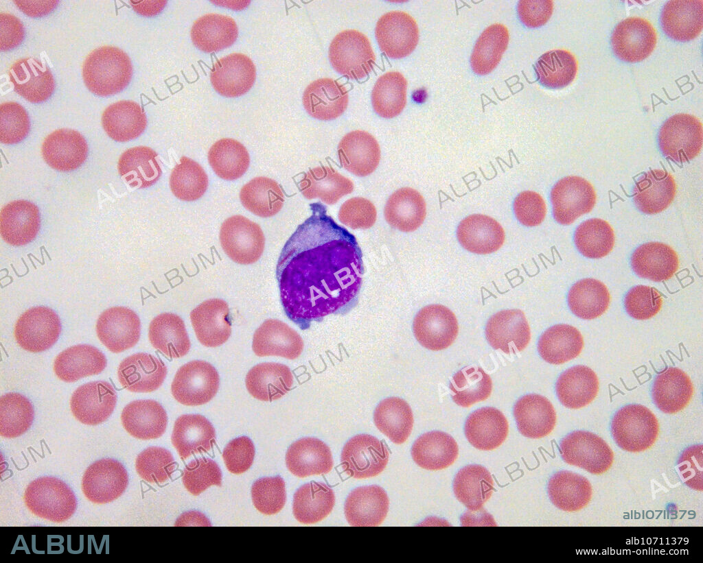Auer rods are clumps of azurophilic granular material that form elongated needles (here, the small red material over the nucleus) seen in the cytoplasm of myeloid leukemic blast. Light micrograph, Wright-Giemsa stain. Magnification: 100x.