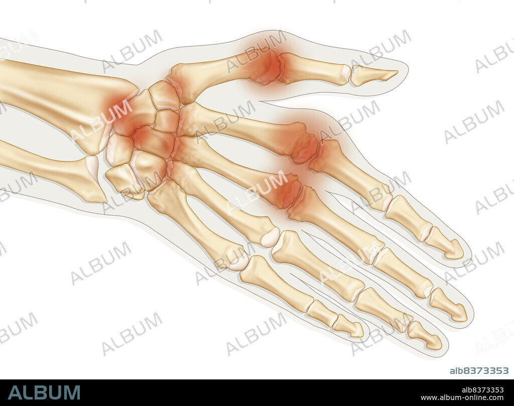 Illustration of a hand suffering from rheumatoid arthritis, with a deterioration of the surface of the bone and cartilage, thickening of the synovial membrane, effusion of synovial fluid and swelling.