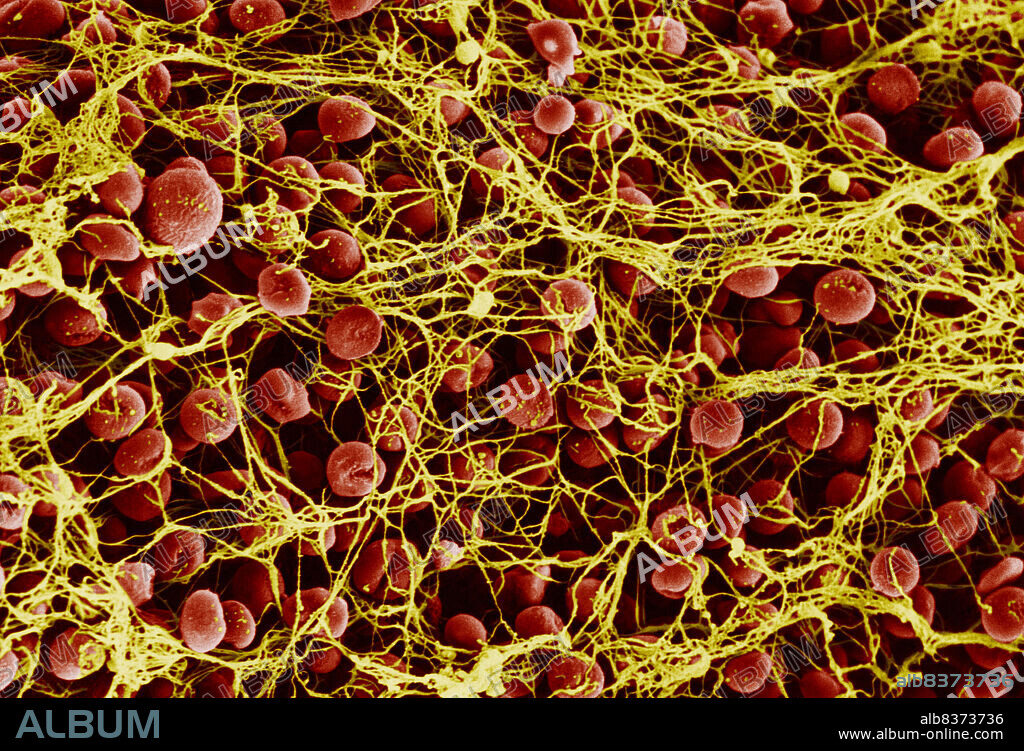 The last step of blood coagulation is marked by the transformation of a soluble blood protein, fibrinogenic, into insoluble fibrin, having the consistency of blood clot. The strands of fibrin forming a network of which the nodes are composed by agregates of platelets surrounding the red blood corpuscles.. SEM x 1800.
