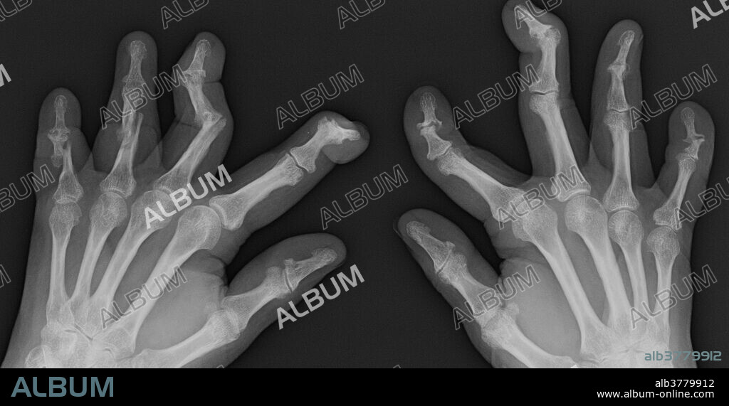 X-ray of the hands of a 58 year old female with psoriatic arthritis. Radiographs reveal sausage digits with severe erosive deformities of the interphalangeal joints, bone production, pencil in cup deformities, ankylosis, and subluxations.