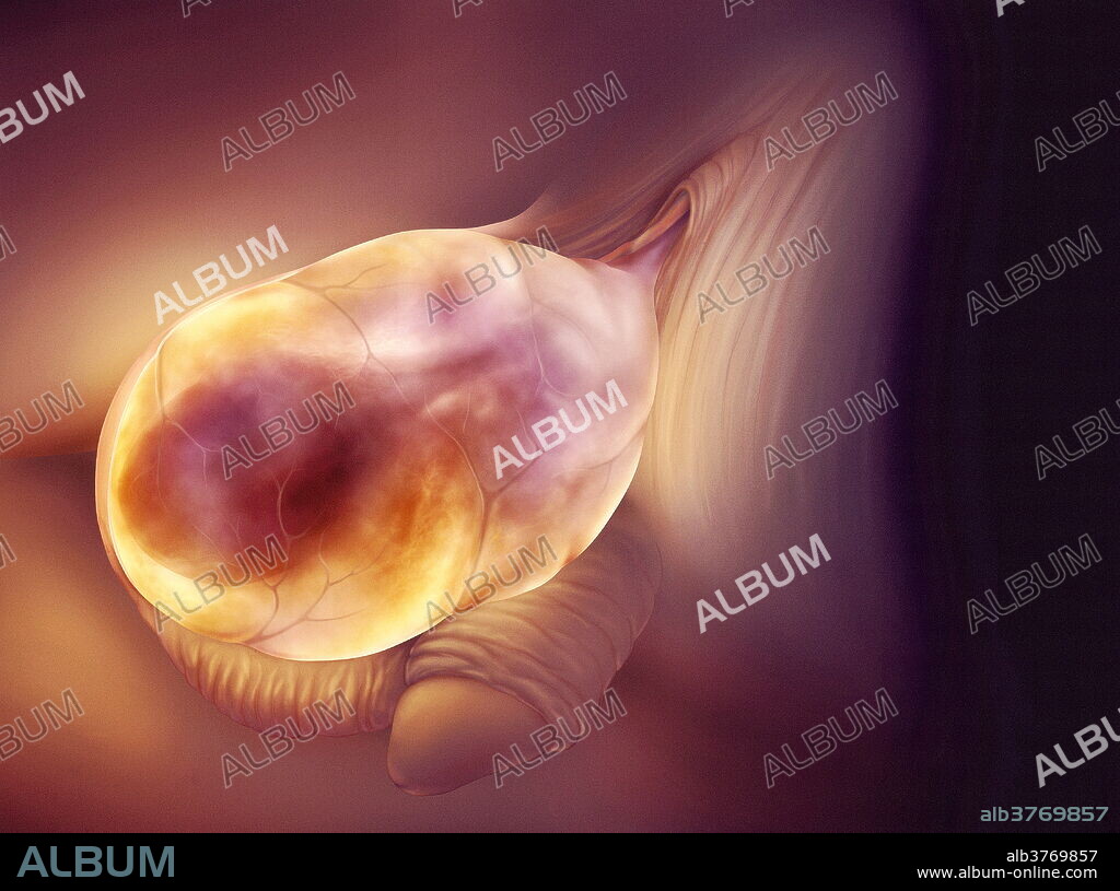 Swollen scrotum. Artwork of an enlarged, swollen scrotum. This is a hydrocele, an accumulation of fluid in the sac surrounding the testes. A hydrocele may be triggered by inflammation, infection or injury to the testes. The condition is generally painless, but if the swelling becomes too large, uncomfortable or painful, it is treated surgically by draining the fluid.
