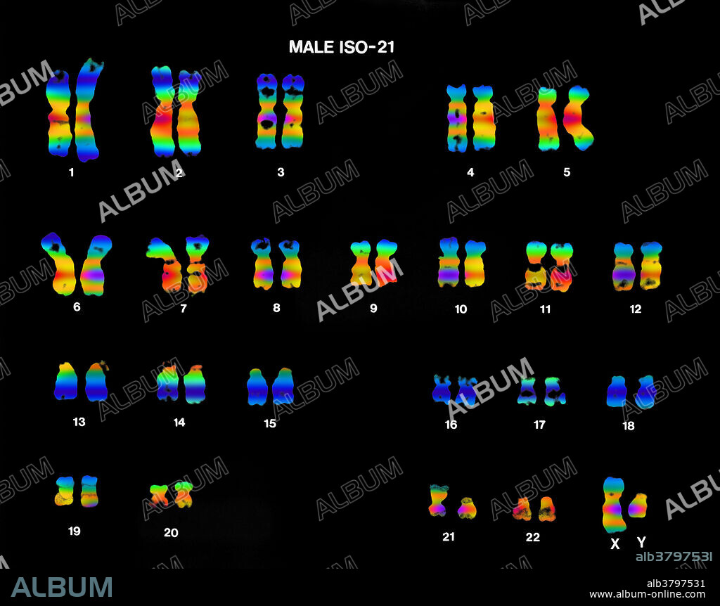 Colour enhanced micrograph of a karyotype showing an isochromosome in pair 21. An isochromosome is a chromosome that has lost one of it's arms and replaced it with a copy from it's other arm.