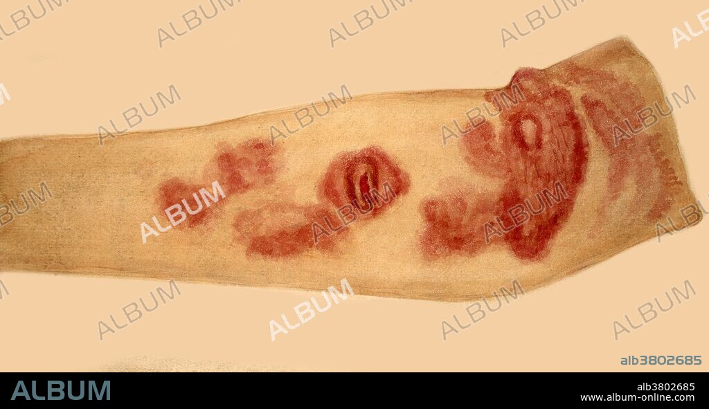 Watercolor drawing of the arm of a woman suffering from mycosis fungoides, also known as granuloma fungoides or Alibert-Bazin syndrome. It is the most common form of cutaneous T-cell lymphoma. It generally affects the skin, but may progress internally over time. Leonard Mark, 1900.