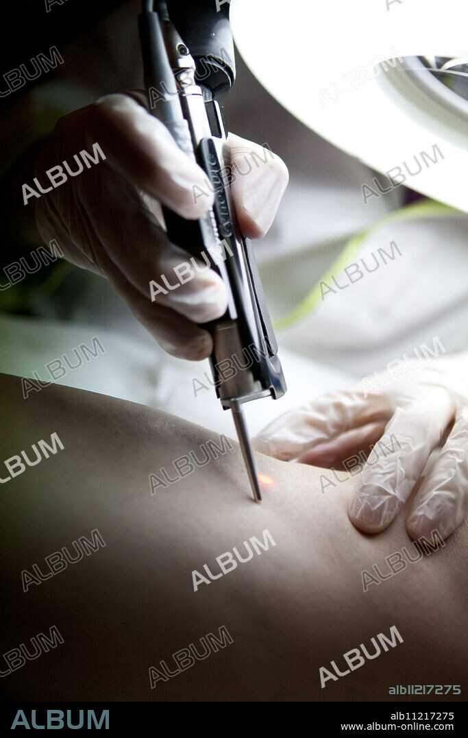 Reportage in a centre for esthetic medecine (Paris). Removal of spider veins on the leg using a Nd:YAG laser.