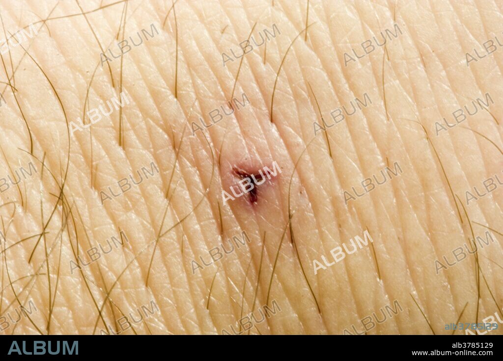 Bite mark on human skin from a Medicinal Leech showing typical Y-shaped pattern. These leeches have 3 jaws with roughly a hundred microscopic teeth. Leech saliva contains an anesthetic which makes the bite virtually painless, a vasodilator which expands the small blood vessels near the bite, an anti-clotting agent which can cause the wound to continue bleeding for many hours after the leech is removed, and even antibiotic agents to prevent infection.