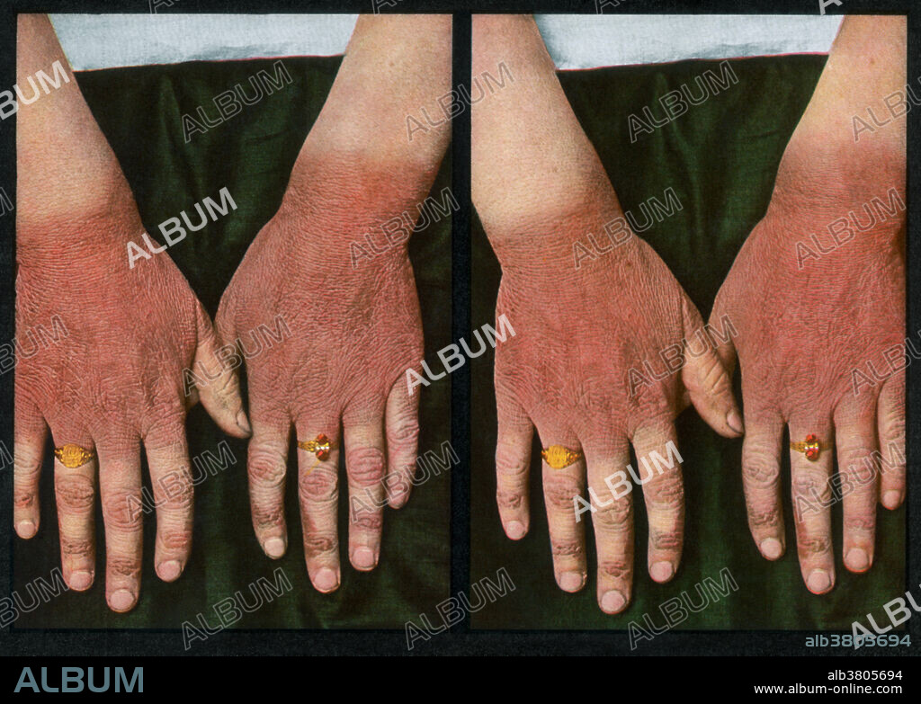 Vintage stereoscopic print from 1910, used to aid in the diagnosis and treatment of dermatological ailments. Here, a patient with dermatitis resulting from pellagra, a vitamin deficiency disease.