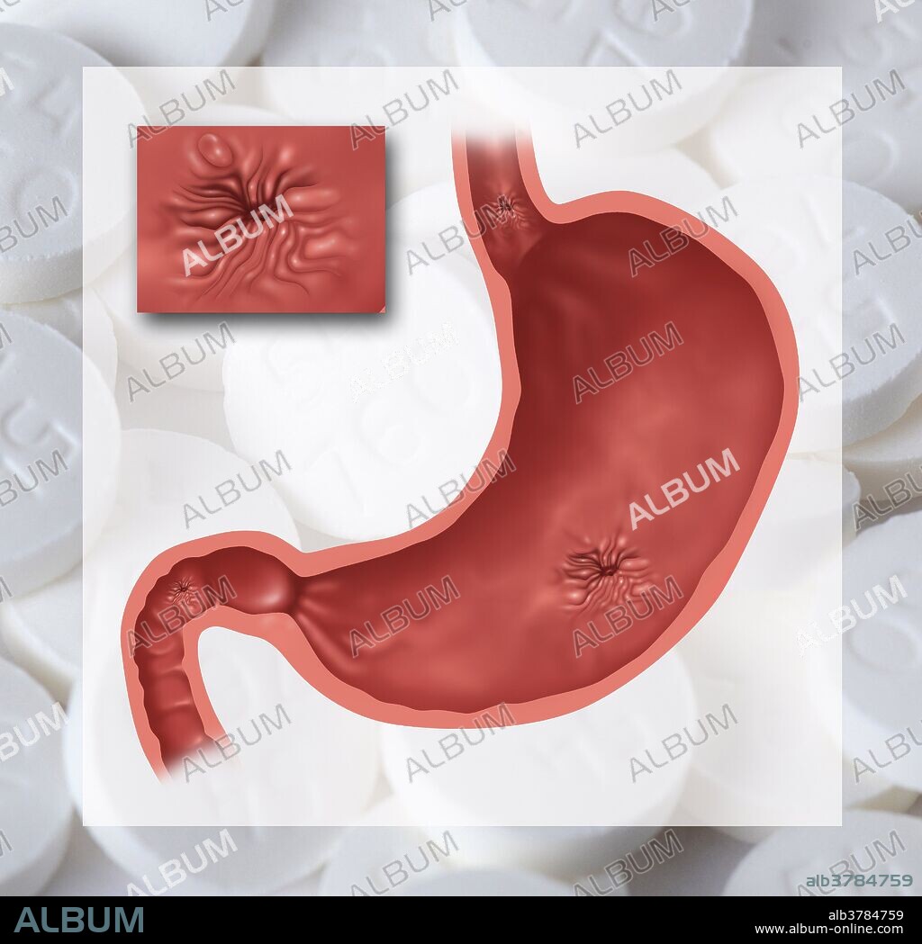 Conceptual illustration of a stomach with several ulcers set on a background of pills. This conceptual image represents one of the dangers of taking too many over-the-counter painkillers. At top is the esophagus and just below that is an esophageal ulcer. In the stomach a gastric ulcer is present, and at the bottom left is a duodenal ulcer in the small intestine. Inset is a close up of a peptic ulcer.