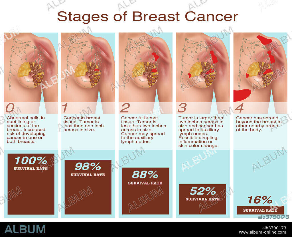 Illustration showing stages of breast cancer and the survival rate at each stage. Starting at the left image 0 shows abnormal cells in duct lining or sections of the breast giving an increased risk of developing cancer in one or both breasts. Image 1 shows cancer in breast tissue, with the tumour being less than 1inch across in size. The 2nd image shows a tumour less than 2 inches wide, and a possibility of cancer spreading to the axillary lymph nodes. Image 3 shows the tumour measuring larger than two inches across in size and cancer has spread to axillary lymph nodes. The final image shows that cancer has spread beyond the breast to other nearby areas of the body.