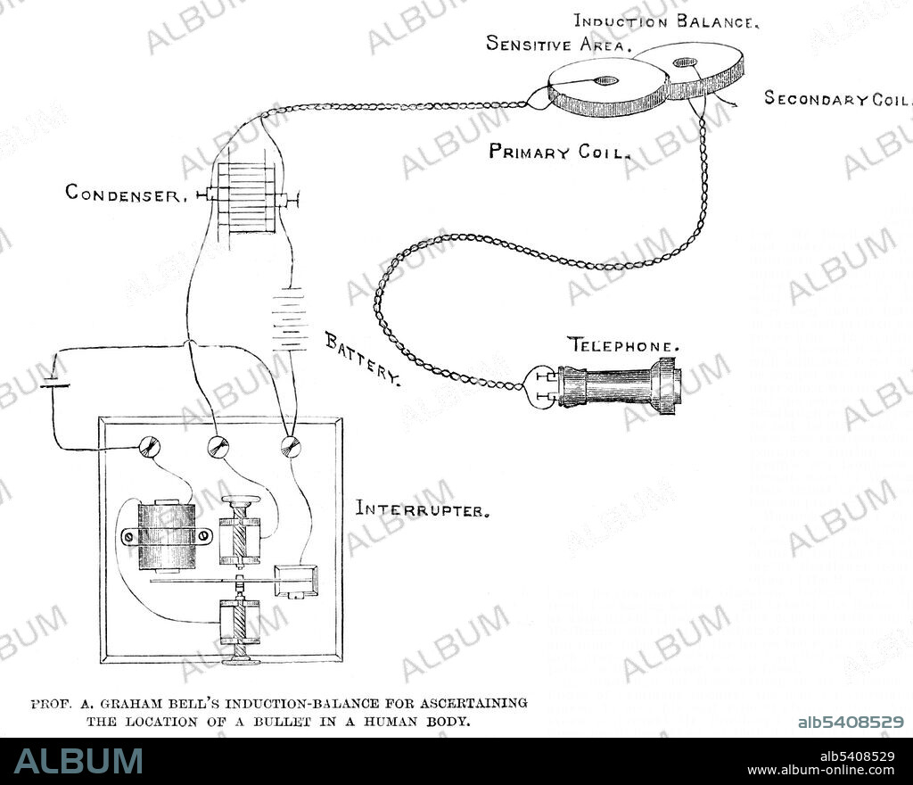 Entitled: "Professor Alexander Graham Bell's induction-balance for ascertaining the location of a bullet in a human body from a sketch by William A. Skinkle." Alexander Graham Bell (March 3, 1847 - August 2, 1922) was a Scottish-American speech therapist and inventor of the telephone. He is also credited with developing one of the early versions of a metal detector in 1881. The device was quickly put together in an attempt to find the bullet in the body of U.S. President James Garfield. According to some accounts, the metal detector worked flawlessly in tests but did not find the assassin's bullet partly because the metal bed frame on which the President was lying disturbed the instrument, resulting in static. The president's surgeons, who were skeptical of the device, ignored Bell's requests to move the president to a bed not fitted with metal springs. Alternatively, although Bell had detected a slight sound on his first test, the bullet may have been lodged too deeply to be detected by the crude apparatus.