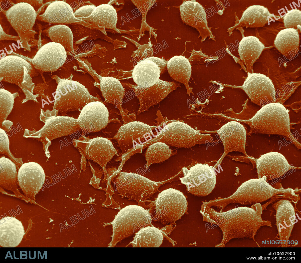 Scanning electron micrograph of human basophils. Basophil is a type of white blood cells. Basophils are the least common of the granulocytes. Basophils contain large cytoplasmic granules which obscure the cell nucleus under the microscope when stained. When unstained, the nucleus is visible and it usually has two lobes. The mast cell, another granulocyte, is similar in appearance and function. Both cell types store histamine, a chemical that is secreted by the cells when stimulated. Magnification @ 1500x, 8x10 print.