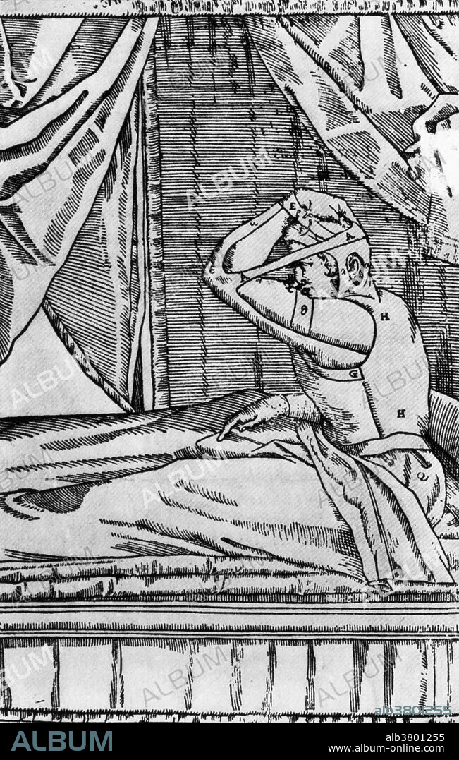 One of Gaspare Tagliacozzi's methods for replacing a missing nose.  Here we see a patient wearing a harness that keeps his nasal area in contact with the incised skin of his arm for a long period of time.  The idea is that the patient will grow a replacement nose from the arm skin.  This method frequently resulted in infection and even death.  Gaspare Tagliacozzi (1547-1599) was an Italian plastic surgeon.  Although reconstructive surgery had been practiced for years, with documented procedures in ancient India, Tagliacozzi popularized the field of plastic surgery, and particularly rhinoplasty, in the 16th century.  His book on plastic surgery, in which this illustration appears, is called De Curtorum Chirurgia Per Institionem (1597).