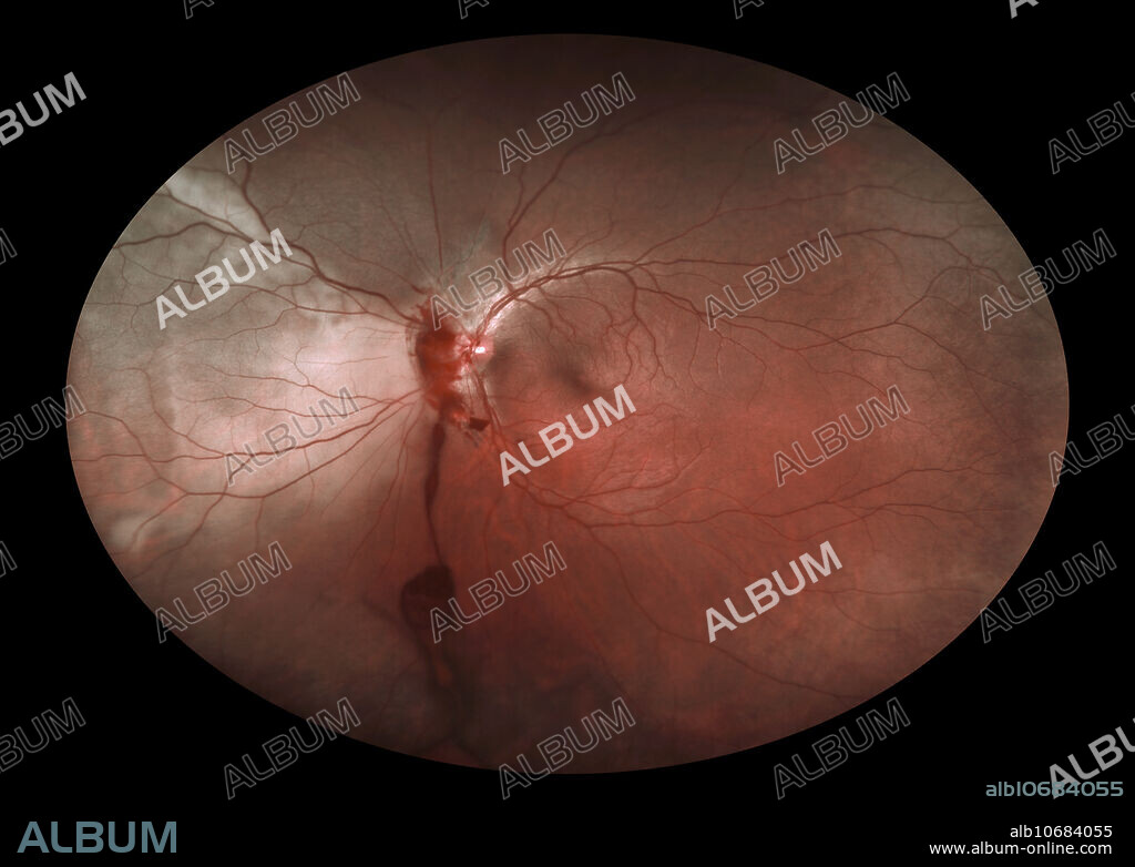 Choroidal rupture, vitreous hemorrhage, and commotio retinae caused by blunt trauma to the eye. The choroidal rupture is located to the left of the optic disc with a vitreous hemorrhage inferior to it. Commotio retinae is the pale area to the left of the rupture caused by the traumatic disruption of the photo receptor layer.