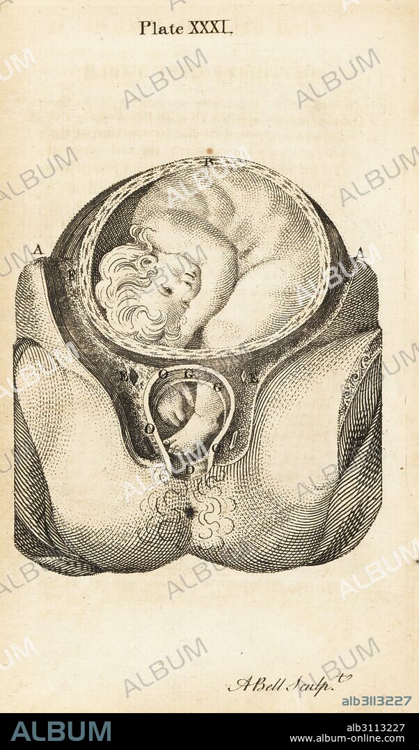 Foetus in breech birth position with foot and hand fallen down into the vagina. Copperplate engraving by Andrew Bell after an illustration by Jan van Rymsdyk from William Smellie's A Set of Anatomical Tables, Charles Elliot, Edinburgh, 1780.