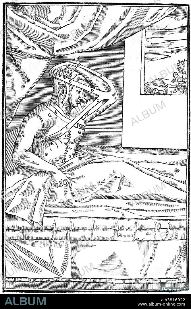 One of Gaspare Tagliacozzi's methods for replacing a missing nose. Here we see a patient wearing a harness that keeps his nasal area in contact with the incised skin of his arm for a long period of time. The idea is that the patient will grow a replacement nose from the arm skin. This method frequently resulted in infection and even death. Gaspare Tagliacozzi (1547-1599) was an Italian plastic surgeon. Although reconstructive surgery had been practiced for years, with documented procedures in ancient India, Tagliacozzi popularized the field of plastic surgery, and particularly rhinoplasty, in the 16th century. His book on plastic surgery, in which this illustration appears, is called De Curtorum Chirurgia Per Institionem (1597).
