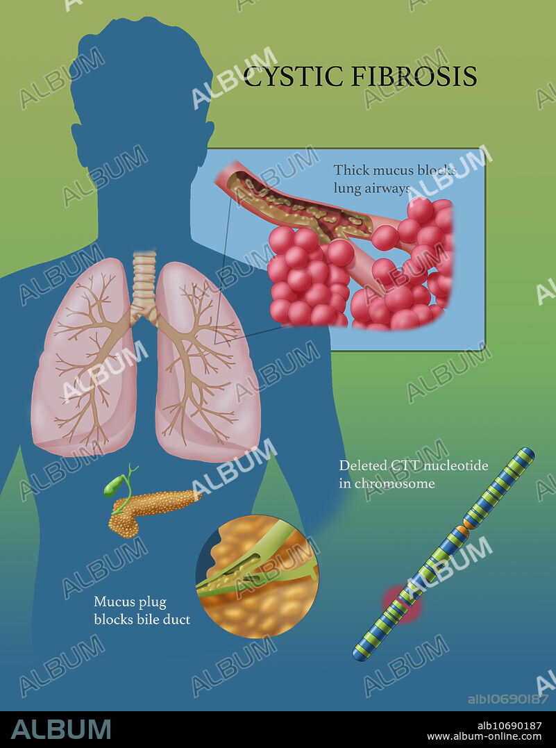 Cystic fibrosis (CF) is a genetic disorder that affects mostly the lungs, but also the pancreas, liver, kidneys, and intestine. Long-term issues include difficulty breathing and coughing up mucus as a result of frequent lung infections. Other signs and symptoms may include sinus infections, poor growth, fatty stool, clubbing of the fingers and toes, and infertility in some males. Different people may have different degrees of symptoms.