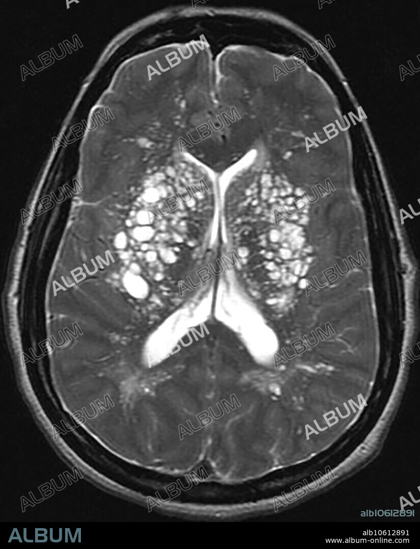 This axial (cross sectional) T2 weighted MR image of an elderly subject demonstrates multiple prominent perivascular spaces (Virchow-Robin Spaces). Visualization of perivascular spaces is a normal finding and when it is very prominent can be confused with a pathologic (abnormal) state.
