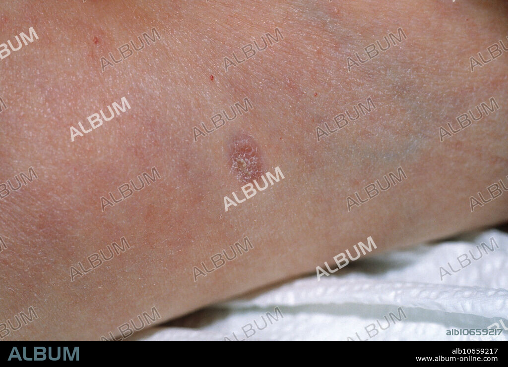 Right leg dimple sign of a dermatofibroma (cutaneous fibrous histiocytoma), a benign skin growth. When lateral pressure is applied, a dermatofibroma will dimple or indent.