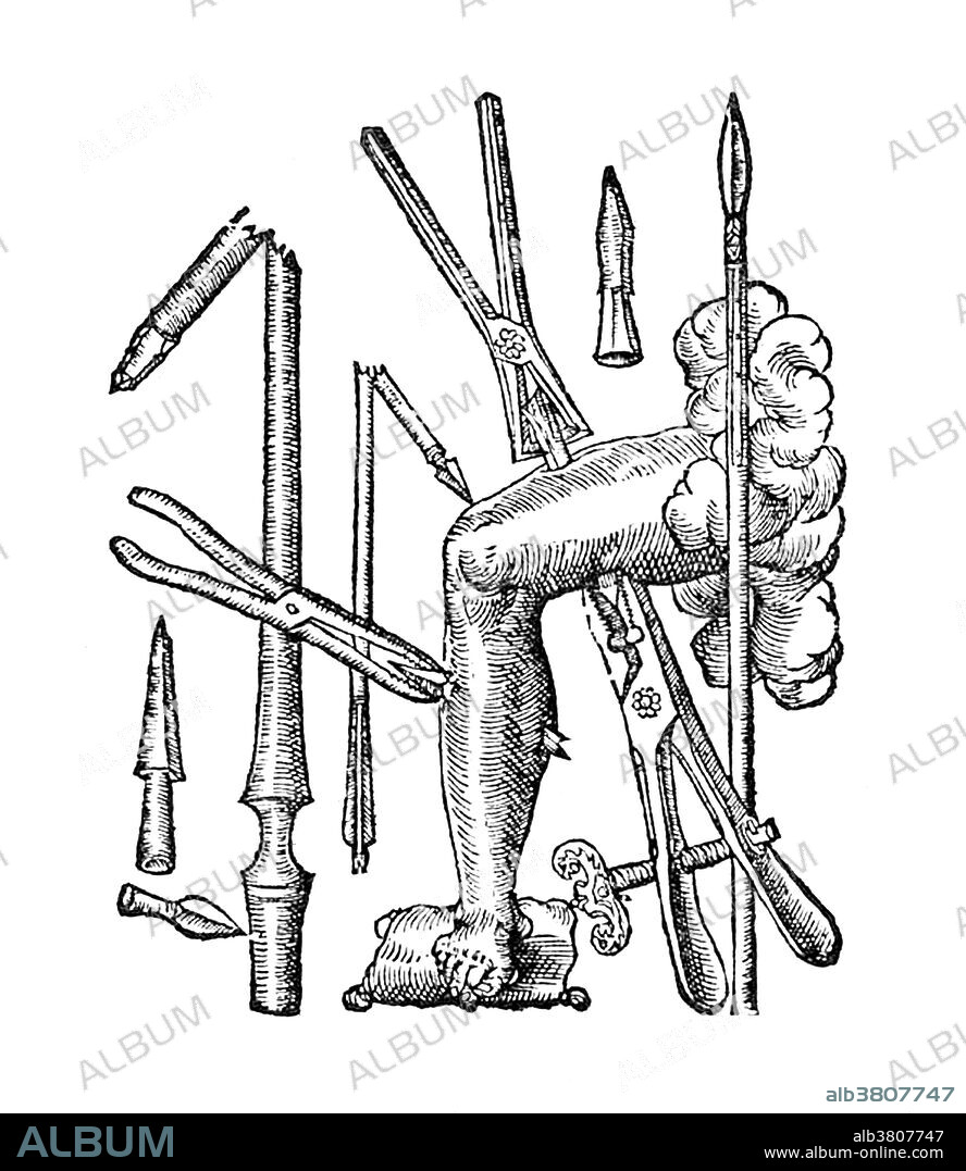 This is a Wound Leg, a quick reference chart for surgeons showing the sort of wound they might expect to encounter on the battlefield, and what tools to reach for first. The accompanying text does not dwell upon the picture a great deal, nor does it explain why only a leg is shown. Many contemporary illustrations show a full figure, with a bloodthirsty array of wounds and weapons. The 1585 edition of ParÃ©'s Oeuvres (Collected Works) represents the final summary of his life's work. It has over twelve hundred folio pages, with nearly 400 illustrations drawing upon a lifetime of practice. Four editions of the Oeuvres were published during his lifetime, and this is the last and the most complete. Often his descriptions of difficult cases end with the same simple sentence, "I treated him, but God cured him." Ambroise ParÃ© (1510 - December 20, 1590) was a French surgeon, anatomist, inventor and one of the fathers of surgery and modern forensic pathology.